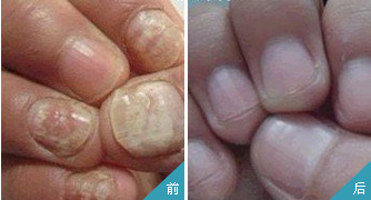 灰指甲怎樣預防呢